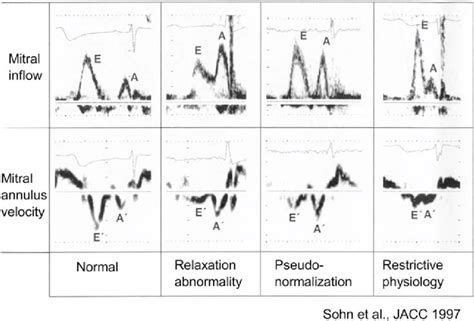 diastolic filling pattern impaired relaxation.